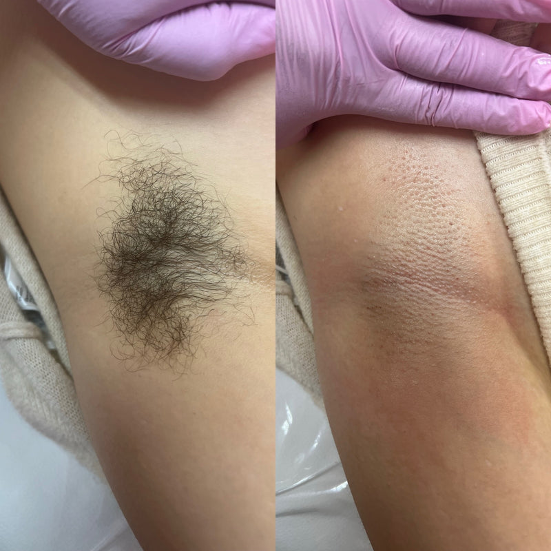 Underarm Waxing